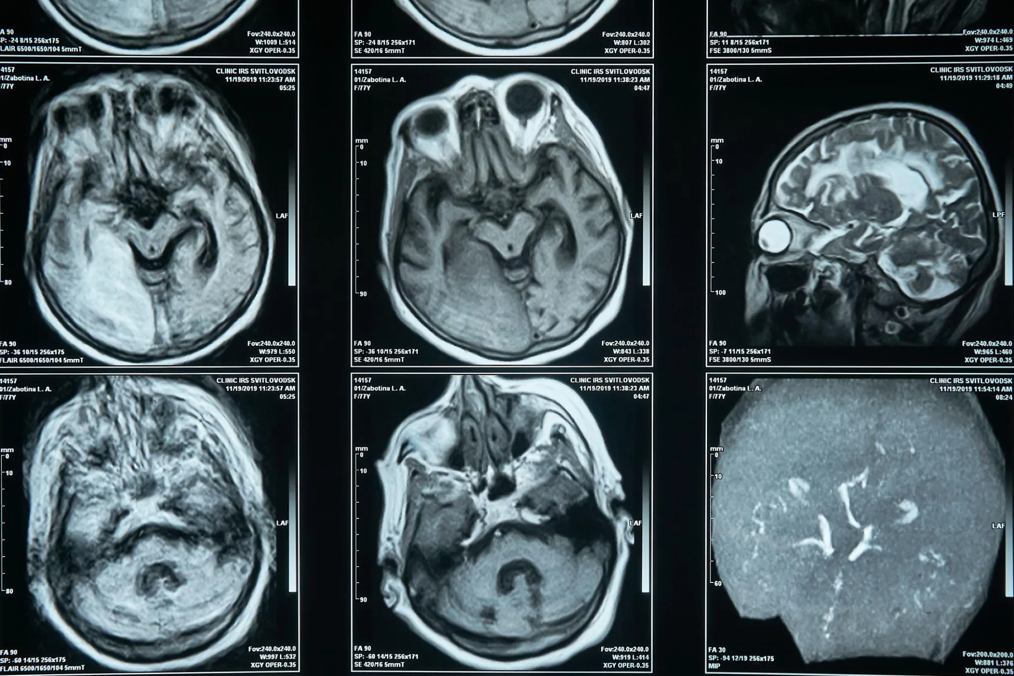 Neuro surgery Consultation